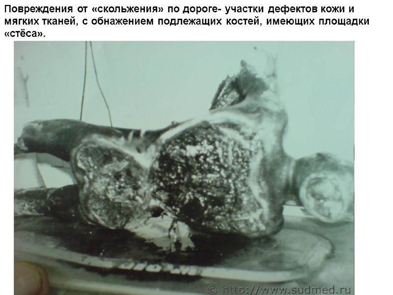 Повреждения от «скольжения» по дороге- участки дефектов кожи и мягких тканей, с обнажением подлежащих